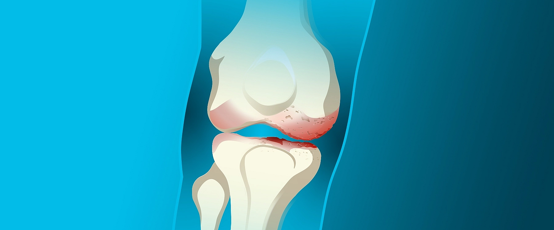 Les injections en combinaison avec l’orthèse OdrA | Une solution efficace pour l’arthrose du genou