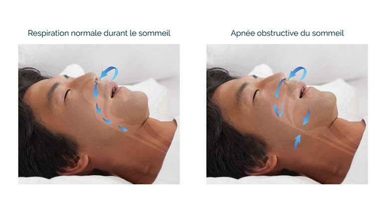 Respiration normale / Apnée obstructive