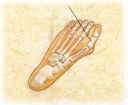 Hallux Valgus