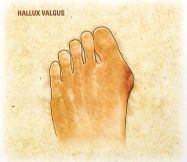 Hallux valgus